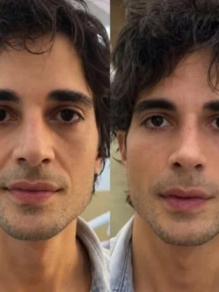Fiuk mostra resultado de harmoniza&ccedil;&atilde;o facial em programa de TV
